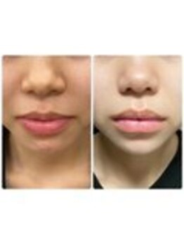 ビューティー モア 長岡店(More)/ハーブピーリング3回目