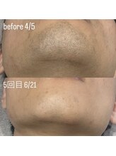 メンズー(MENZOO)/