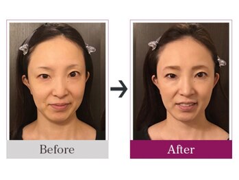 ビコツゼロ 青山(BIKOTSU ZERO)/小顔・顎の歪み・目の高さ違い