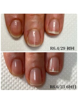 最強のネイルケア☆地爪育成