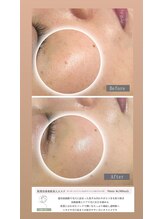 ラ レーヌ(La-leine)/フェイシャルエステ90分コース