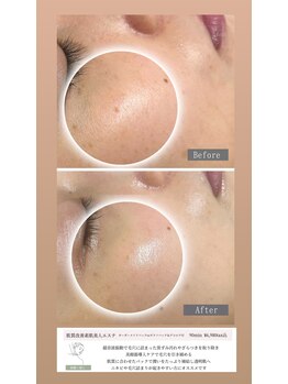 ラ レーヌ(La-leine)/フェイシャルエステ90分コース