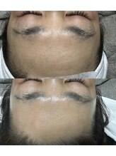 ラニー アンド ココネイル(LANIE&CocoNail)/フェイシャルワックス×Lit