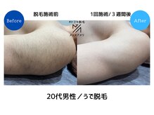 メンズアメリ/高知/メンズ脱毛/ヒゲ/全身/VIO