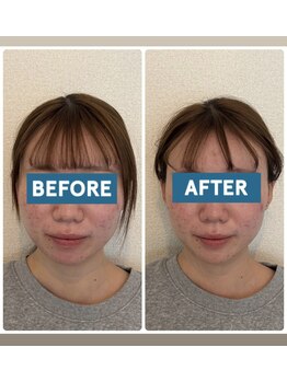 ル メルシェ(Lemerci)/初回 Before After