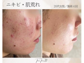 スリースリー(THREE THREE)/ニキビ・肌荒れ