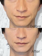 ルミライ(Lumirai)/ 小顔だけじゃない美肌も一緒に