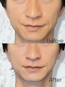 ルミライ(Lumirai)/ 小顔だけじゃない美肌も一緒に