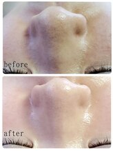 シャルマン/鼻の黒ずみよ「さらば」