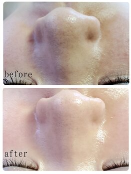 シャルマン/鼻の黒ずみよ「さらば」