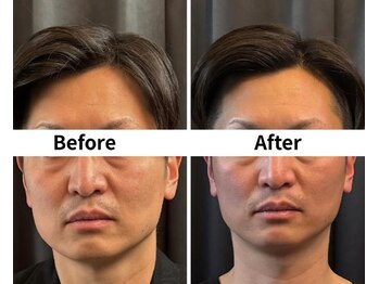 アロエベル(aloe Belle)/Before After（1回施術）