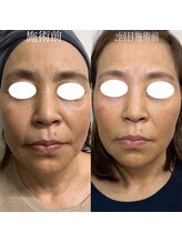 コリー(Kolly)&nbsp;小顔リフト アップ