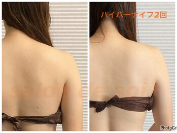 サロン ド ソワ(salon de soi)/花嫁さんの大事なライン　首肩