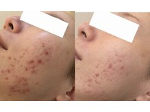 スリリアン 銀座/★ニキビ劇的ビフォーアフター★