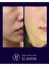 小顔・脂肪コントロール専門 salon de nurse U.sona～松本店～/【韓国基礎化粧品で肌質改善】