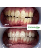 ホワイトニングサロン 名古屋駅店/【ホワイトニング施術例】