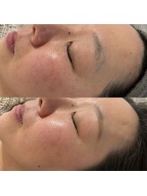 ルブール(levure)/フェイシャルワックスで-10歳肌