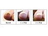 【2回目以降の方はこちら】巻き爪矯正（2本まで）30分