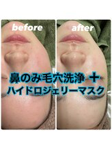 クラリ(Clari)/毛穴洗浄福岡人気/毛穴洗浄福岡