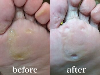 ドクターネイル爪革命 札幌本店/症例紹介18 たこ・うおのめ