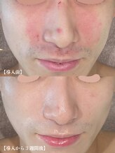 ゼアー(THERE FY.)&nbsp;生エクソ ソーム導入