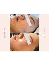 ラグラン銀座メディカルエステ 高輪ゲートウェイ店/メンズケアセルマジ・ビフォアフ