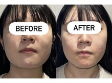 レシェルサロン(Lechelle Salon)/小顔矯正