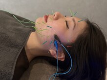 ミトノウ(MITONOU)の雰囲気(美容鍼でお顔をキュッと引き締める◎SNSで話題のメニューです☆)