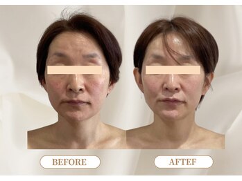 トロワ(TROIS)/小顔だけじゃない美肌も叶う