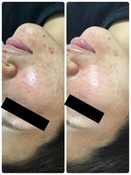 メイユール(MEILLEUR)/光フェイシャル