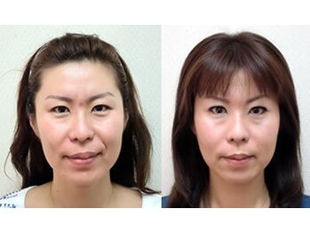 フィシス/ほうれい線と眉間のシワ改善