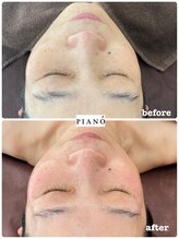 ピアーノ(PIANO)/エルモサハーブピーリング