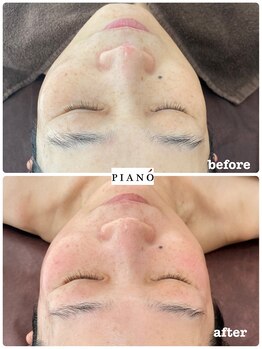 ピアーノ(PIANO)/エルモサハーブピーリング