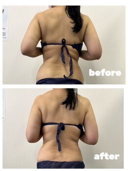 ヤン リン 整体(Yang Ling 整体)/痩身【背中】