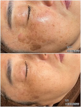 桜/シミ・お肌の色ムラ改善メニュー