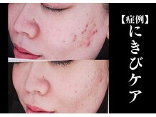 The水光美肌専科/何をしてもダメだったニキビケア
