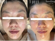 シードリン(Seedling)/ブライダルエステ