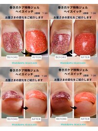 巻き爪ケア変化