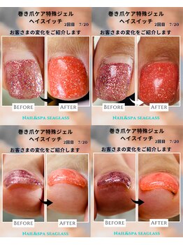 シーグラス(SeaGlass)/巻き爪ケア変化