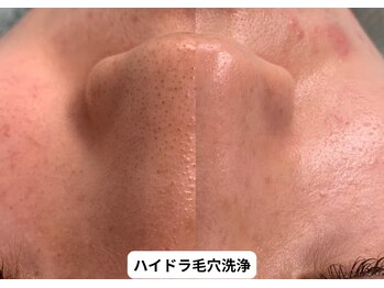 リメイク 銀座(REMAKE)/ハイドラ毛穴洗浄