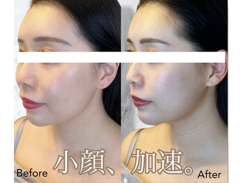 ルミライ(Lumirai)/たるみ改善|毛穴|フェイシャル