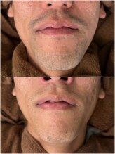 ロジュマンアンドクレア(LOGEMENT&Crea.)/ヒゲ脱毛