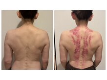 ムーンリット(moonlit.)/かっさデトックス