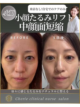 シェリー(Cherie)/たるみ改善・中顔面短縮