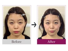 ビコツゼロ 青山(BIKOTSU ZERO)/小顔・口角の高さ違い