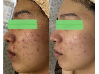 マーレン(Malen)/【クリスティーナ症例写真】