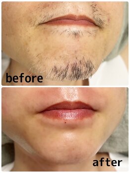 グロス(GLOSS)/【ダブル脱毛】ワックス+光脱毛