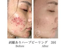 ミーシェ(Meshie)/リベルハーブピーリング施術前後
