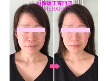 小顔矯正サロン セラフィ/1回目の変化♪顎ラインすっきり