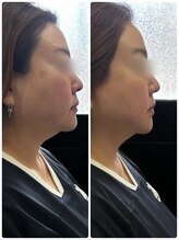 ドゥーソル 谷町四丁目店(due sole)/谷四/レモンボトル2cc